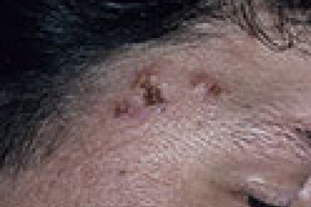 Dermatitis herpetiformis op hoofd