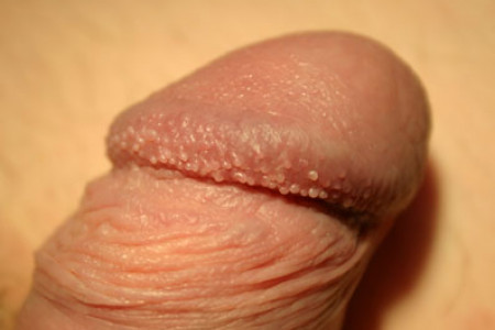 Pearly Penile Papules1