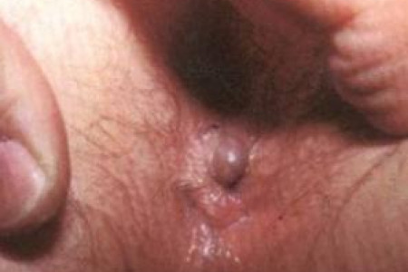 Peri-anaal thrombose