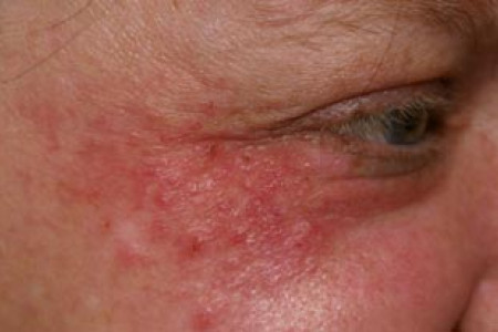 Periorale dermatitits rond oog