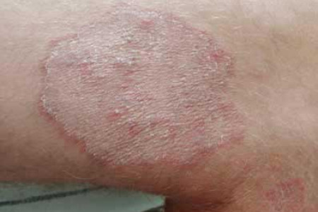 Schimmelinfectie (ringworm) van de huid