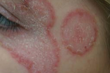 Schimmelinfectie (ringworm) van de huid op het gelaat
