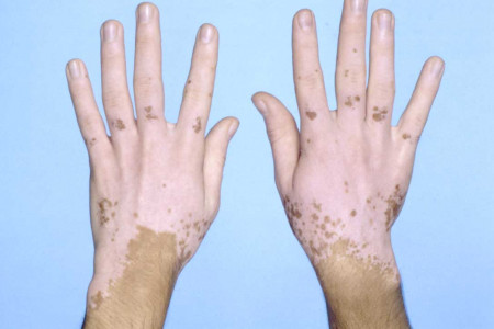 Penis vitiligo Vitiligo on